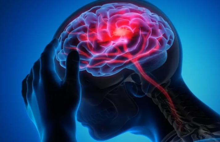 Gliomas: Tipos, Síntomas y Tratamientos