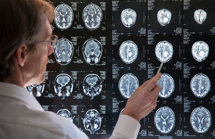 ¿Qué es un Meningioma?