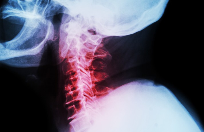 Mielopatía Cervical: Causas, Síntomas y Tratamiento