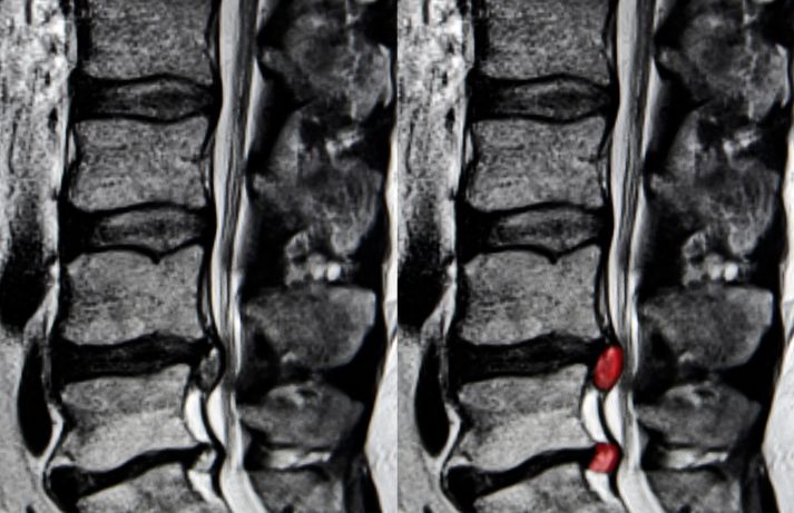 Ciática y Discos Intervertebrales Herniados